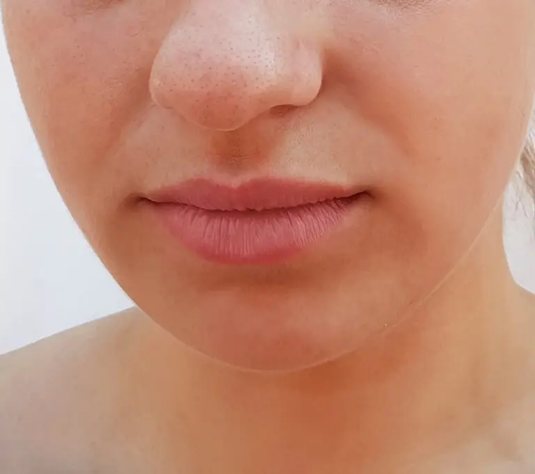 Restylane_injection_after