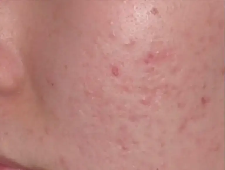 acne-after