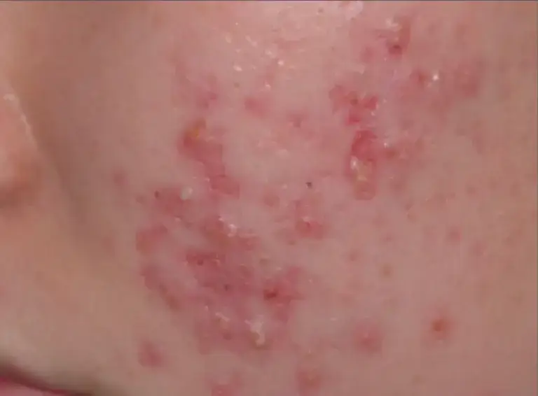 acne-before